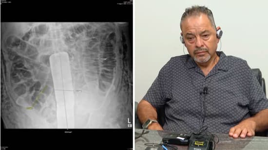 Hispano ingresó a cirugía por un tumor en el páncreas y salió con un metal dentro de su abdomen