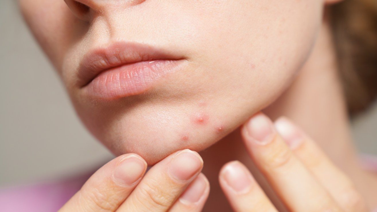 Mujer acabó hospitalizada en Míchigan y con el rostro paralizado tras reventarse un grano