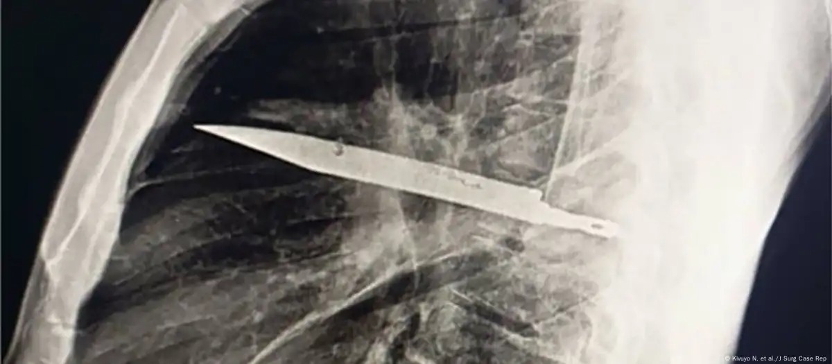 ¡Insólito! Médicos hallaron un cuchillo enterrado durante ocho años en el tórax de un paciente