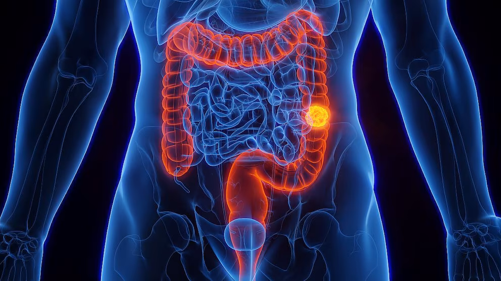 Cáncer de colon en jóvenes: la delicada advertencia sobre un factor de riesgo que suele subestimarse