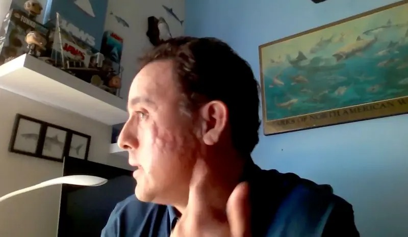 El impresionante relato del latino que sobrevivió a la mordida de un tiburón en la cabeza