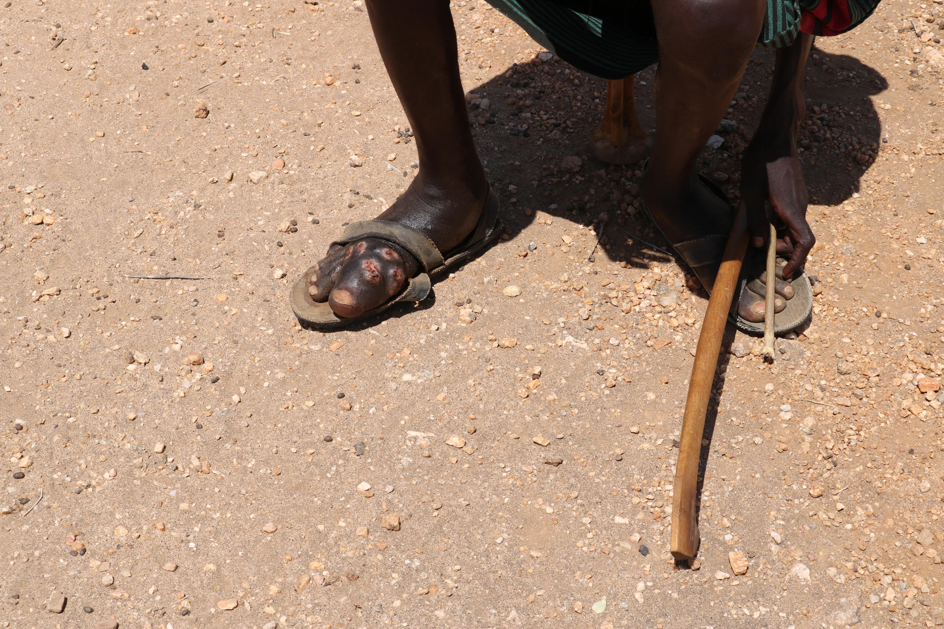 "Como si me comiera desde dentro": la enfermedad que ataca los huesos en el norte de Kenia