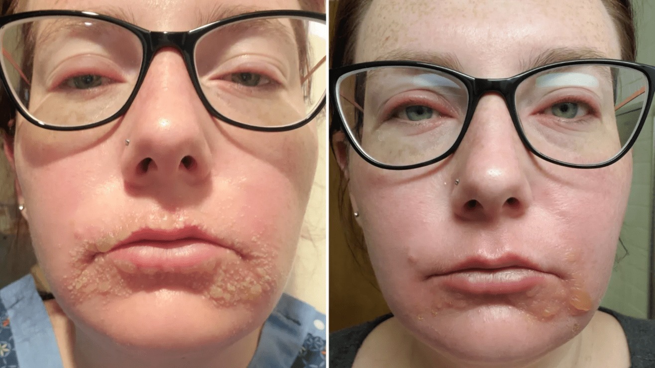 El singular caso de "mujer vampiro": fue diagnosticada con una rara enfermedad