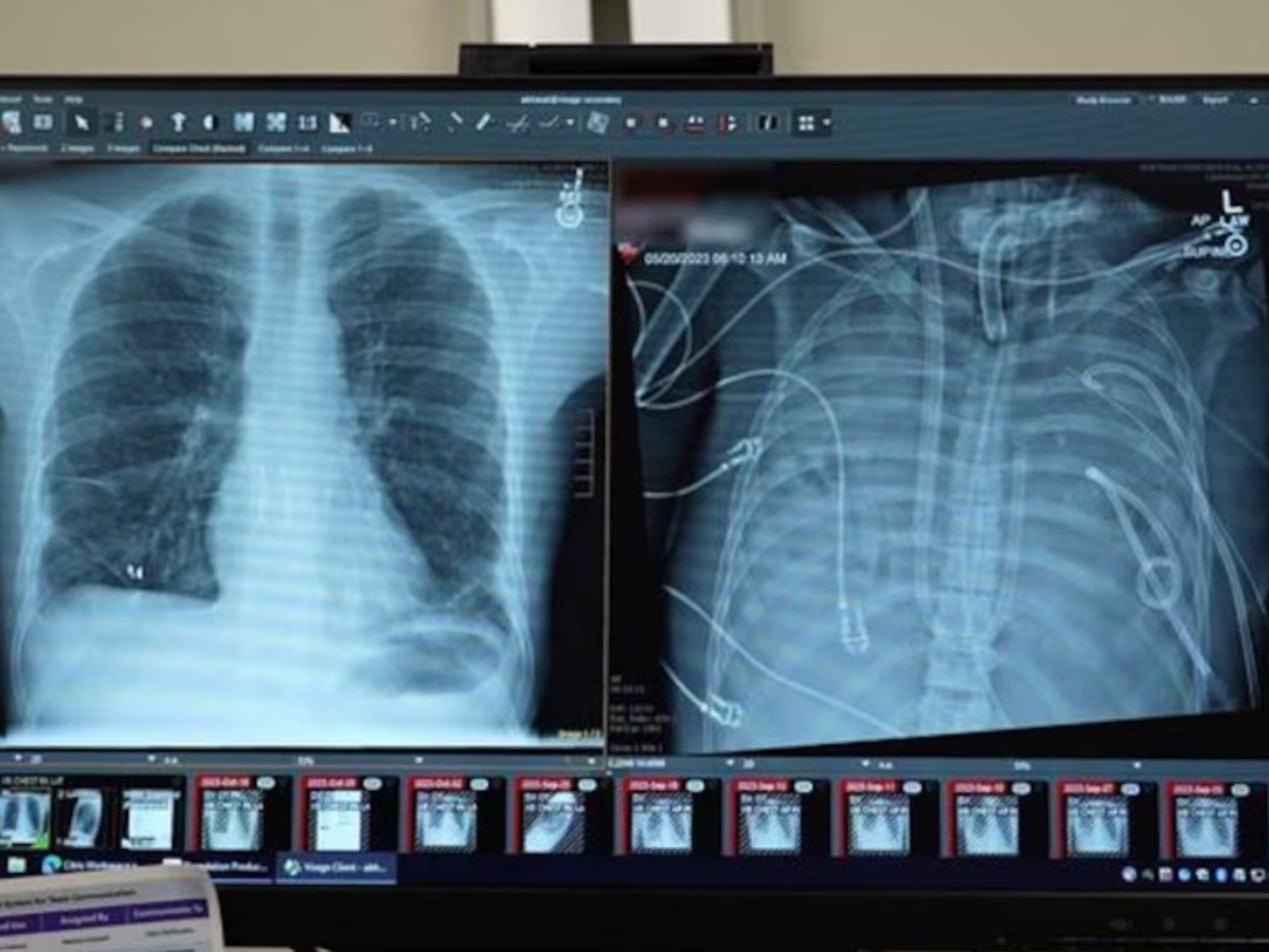 La increíble historia del hombre que vivió 48 horas sin pulmones en EEUU