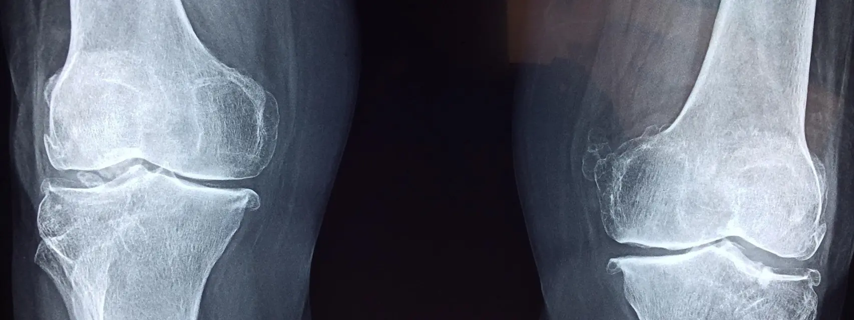 Así debilita los huesos la exposición a químicos presentes en el agua y otros productos cotidianos