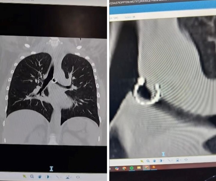 Empezó a toser y un mes después descubrió un objeto insólito en sus pulmones
